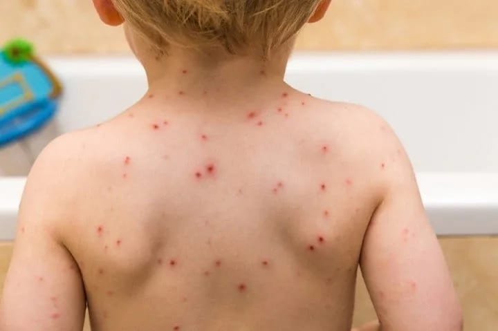 "Epidemija morbila može da plane kao požar, roditelji da vakcinišu djecu"