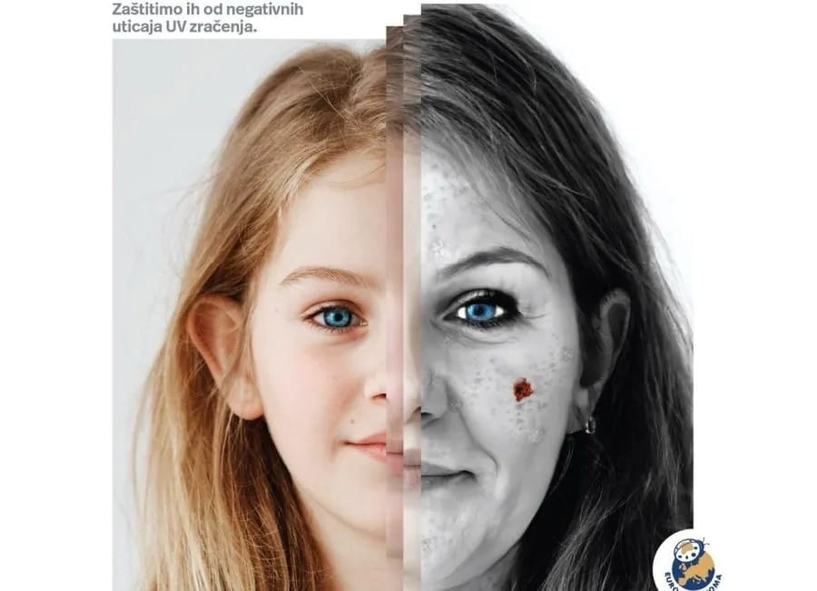 KCCG: Broj oboljelih od melanoma neprestano raste