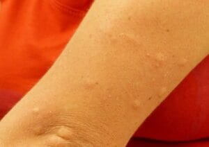 stitches-186427_960_720